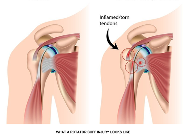 FOUR COMMON BADMINTON  INJURIES & HOW TO PREVENT THEM